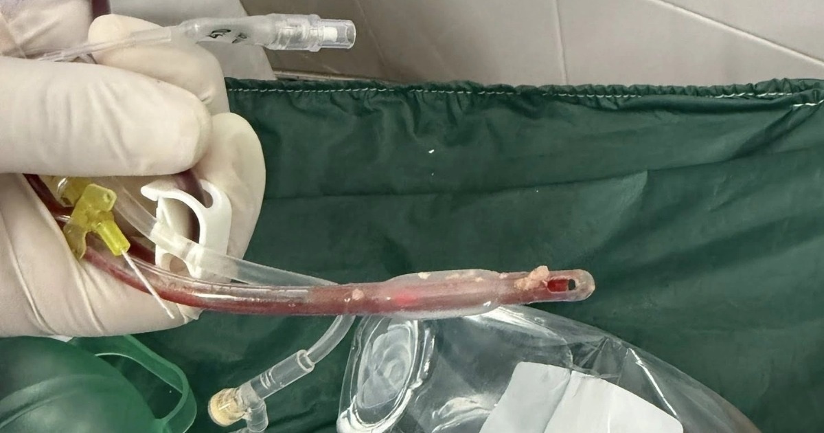 TPHCM: Ho sặc khi ăn ở nhà trẻ, bé gái 3 tuổi tử vong thương tâm