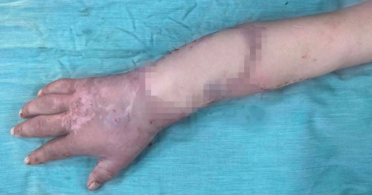 Thai phụ được ghép tạm tay đứt lìa vào chân đã thực hiện ca mổ "định mệnh"